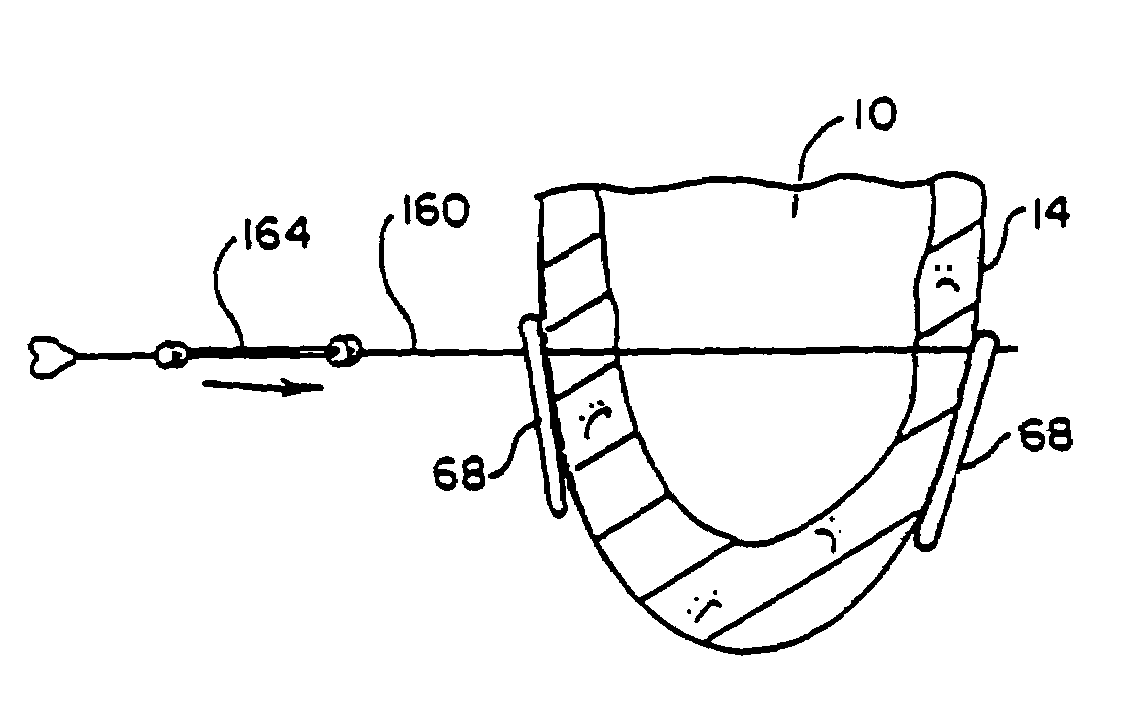 Heart wall tension reduction apparatus and method