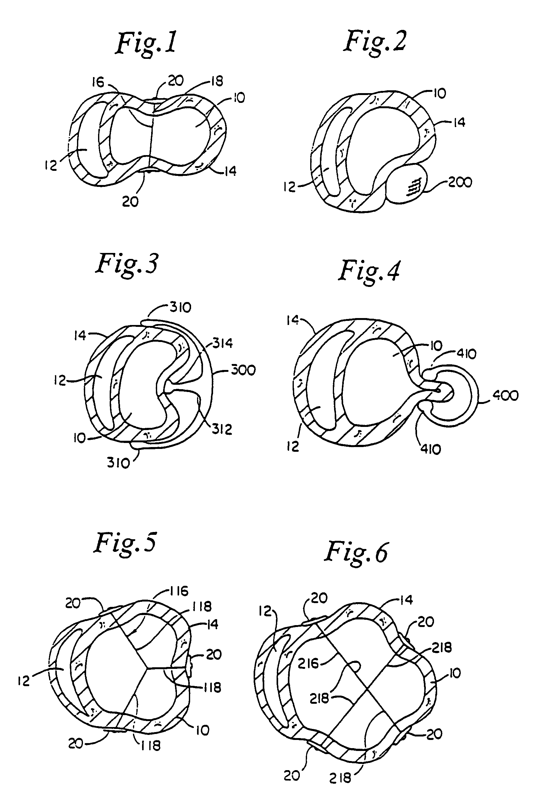 Heart wall tension reduction apparatus and method