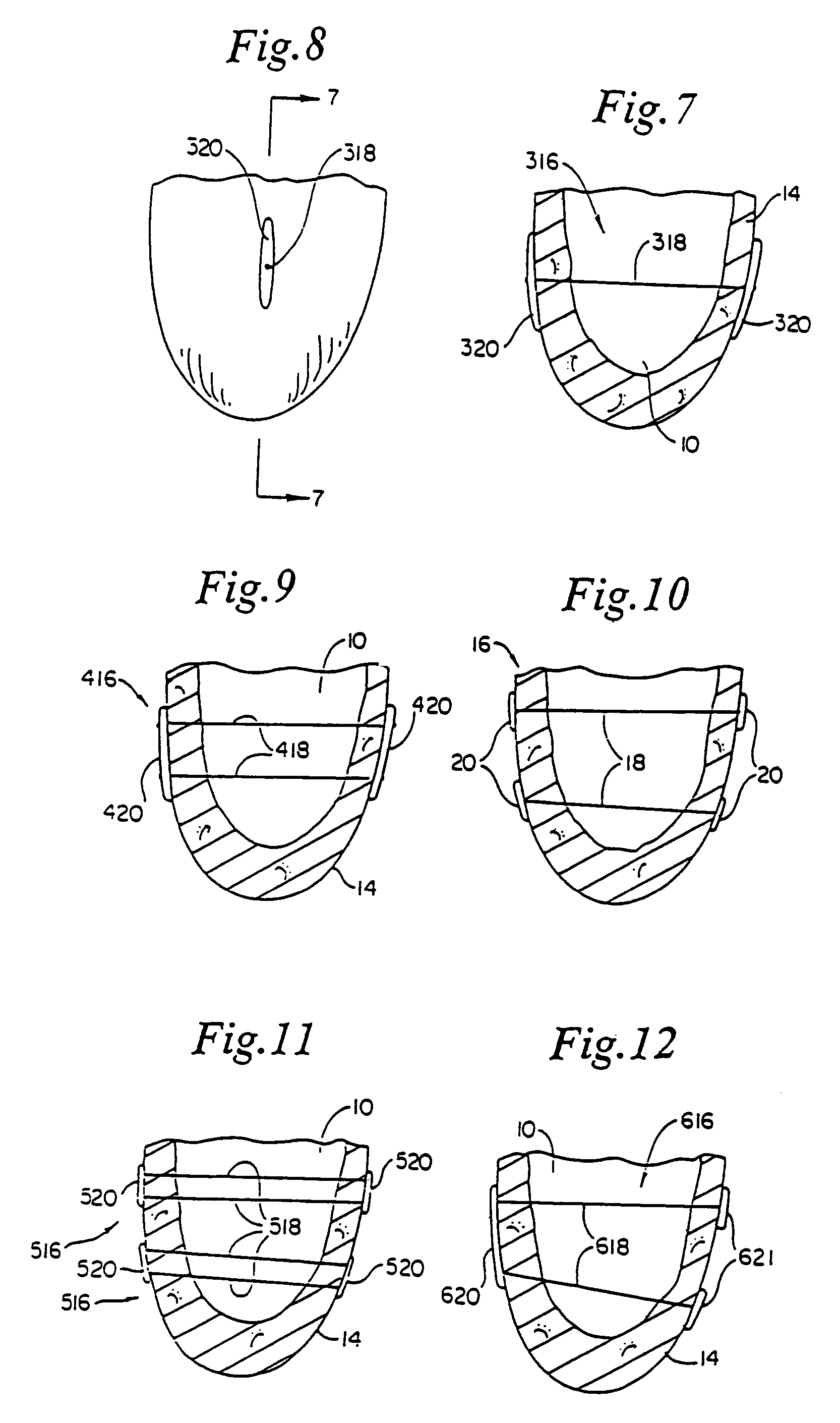 Heart wall tension reduction apparatus and method