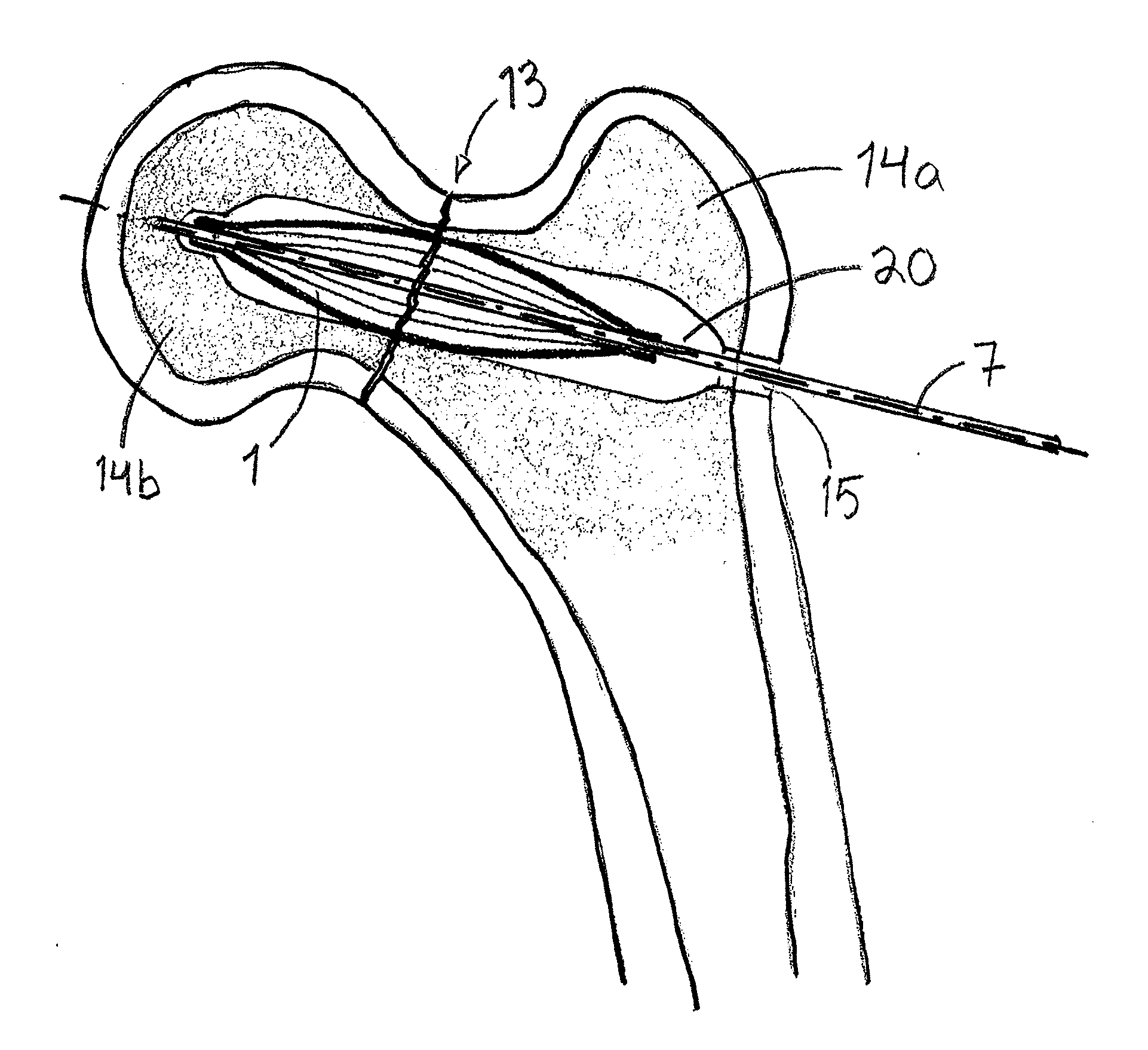 Arrangement for internal bone support