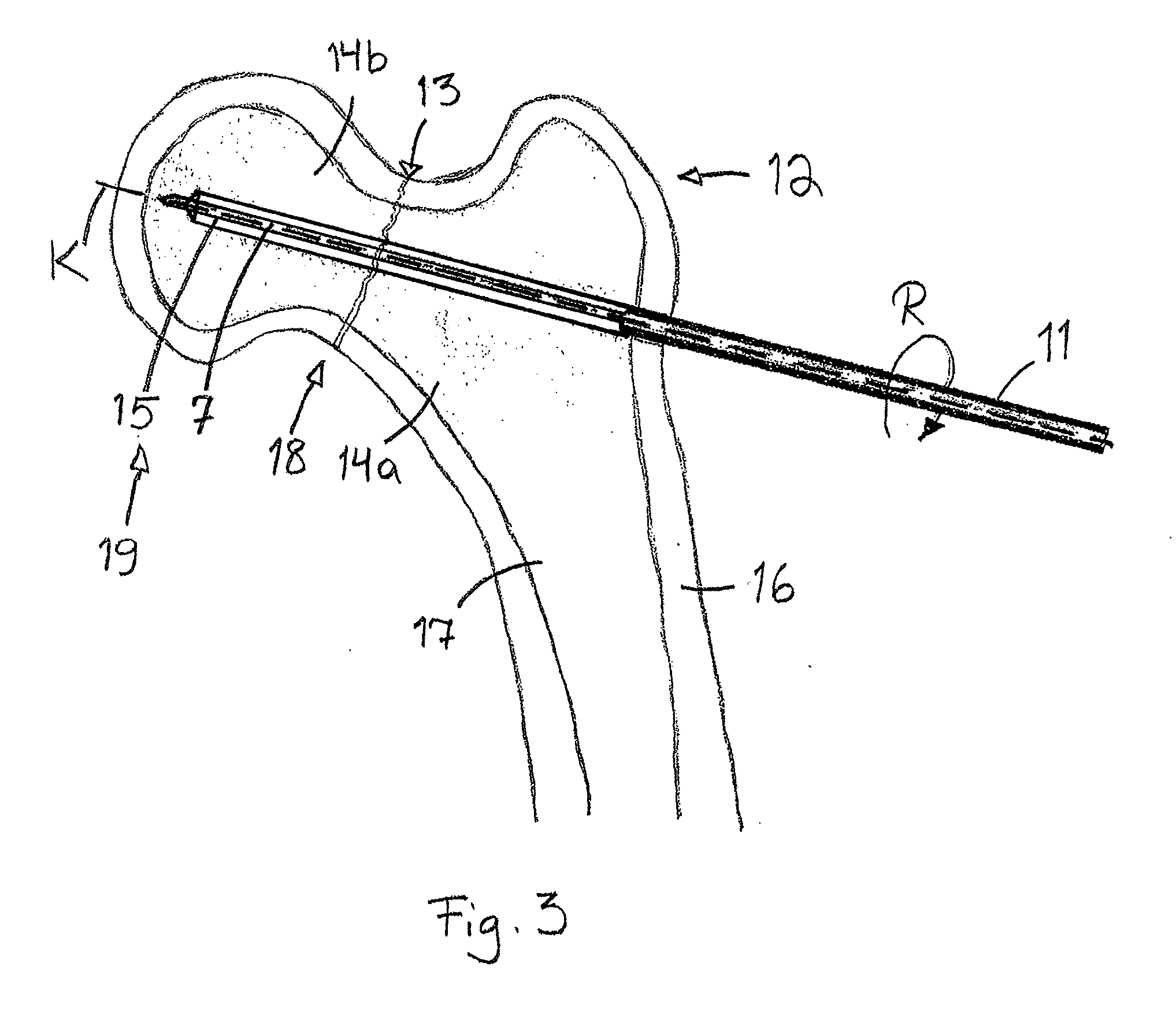 Arrangement for internal bone support