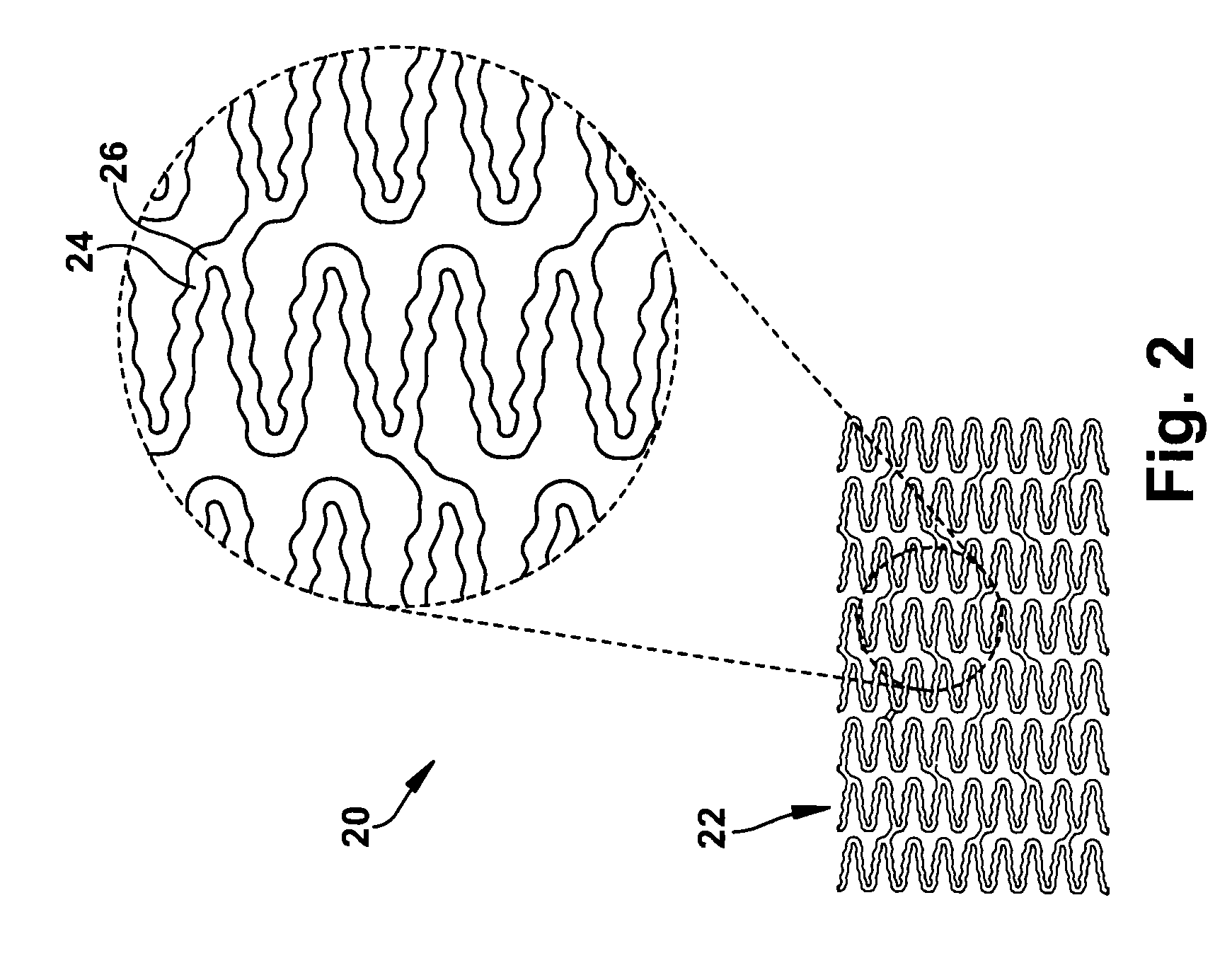 Stent having a bridge structure