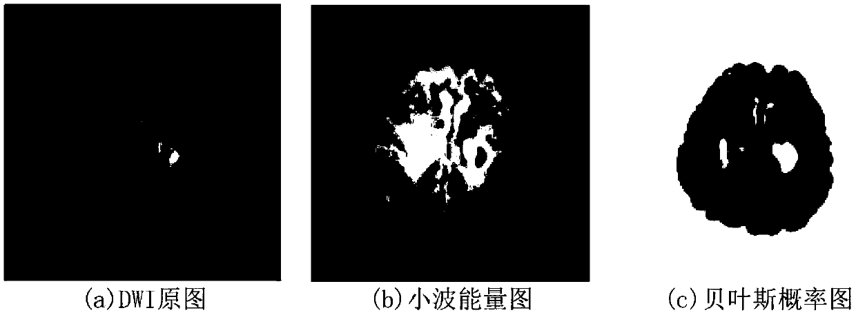 A cerebral arterial thrombosis image segmentation method