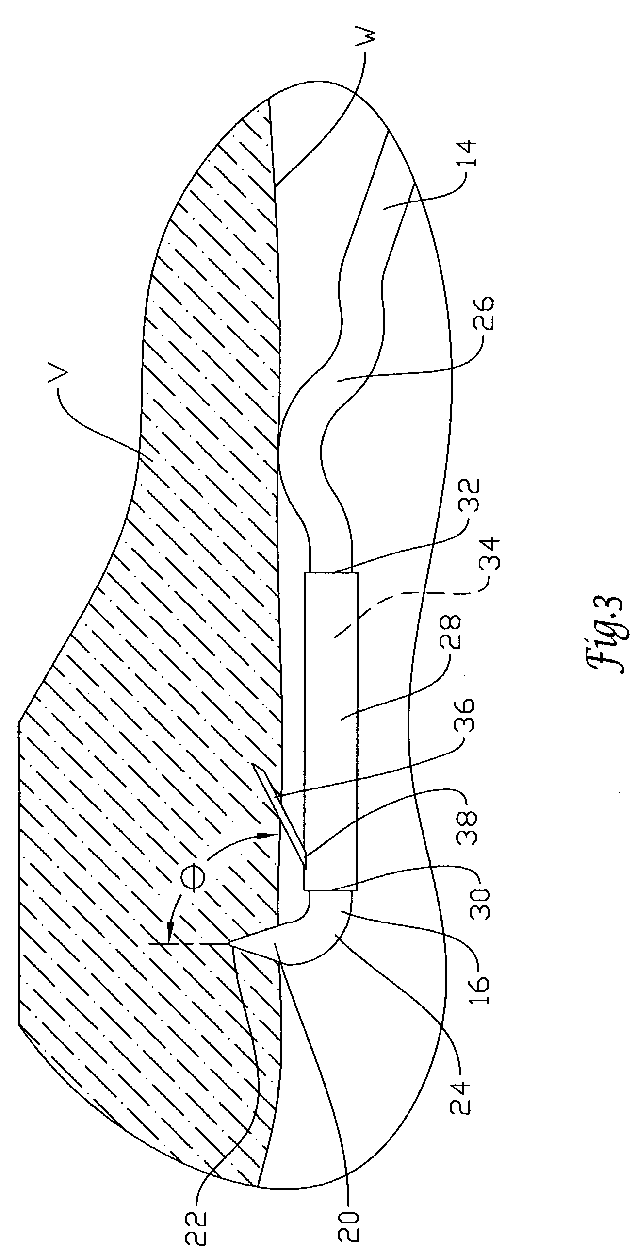 Retrievable IVC filter