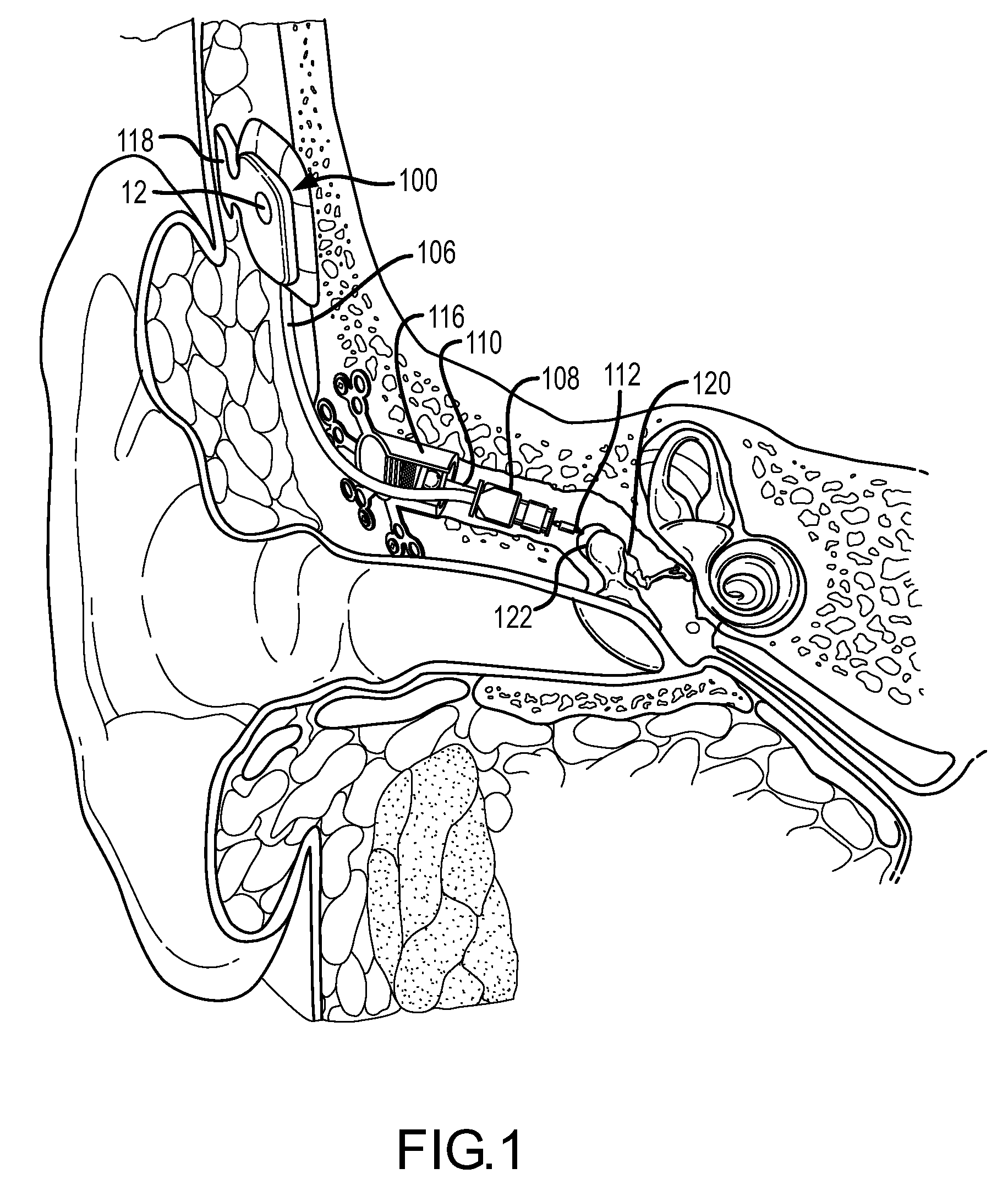 Dual feedback control system for implantable hearing instrument