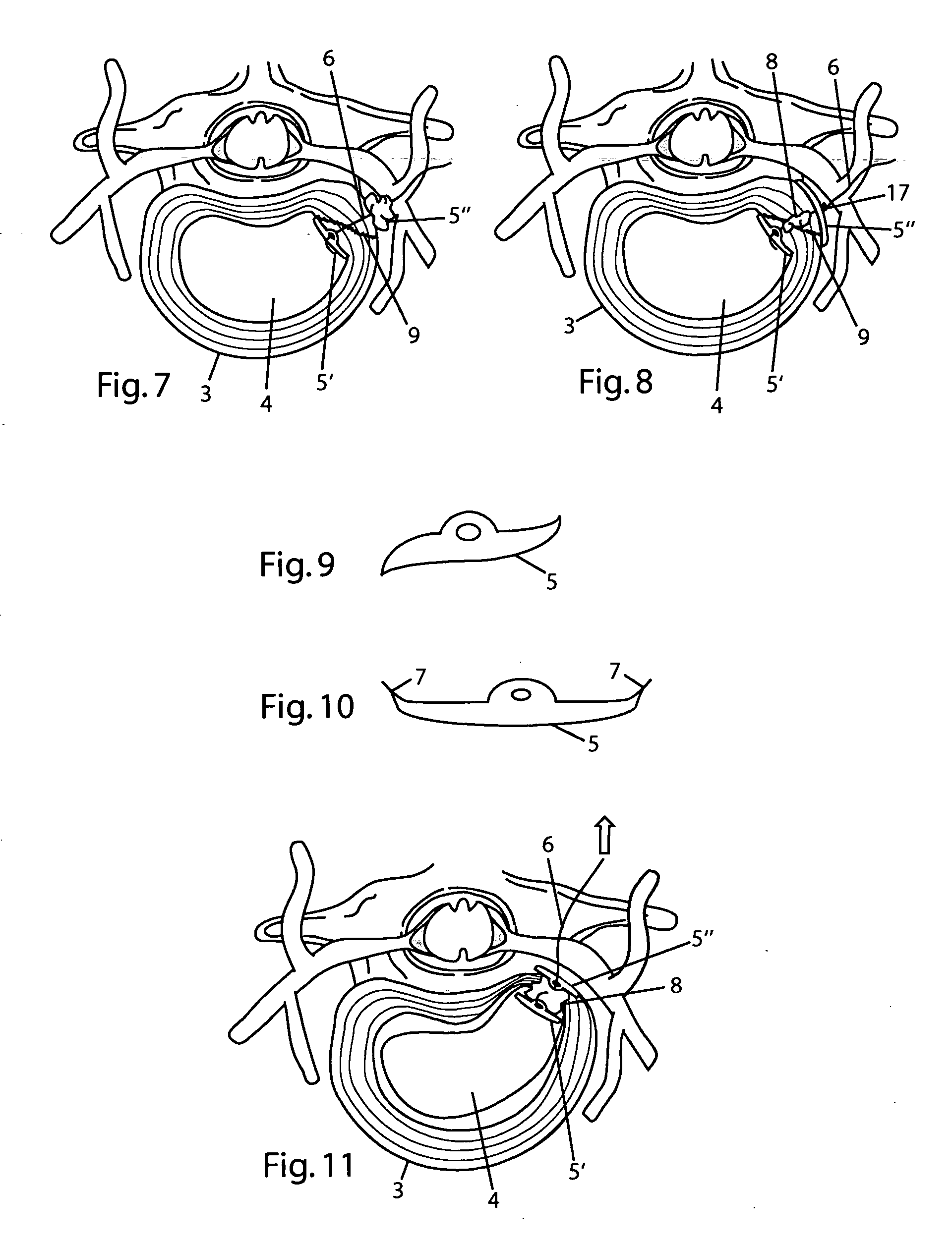 System and devices for the repair of a vertebral disc defect