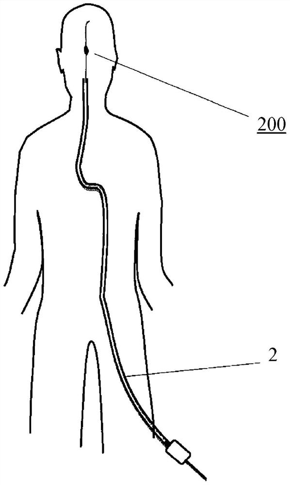 Apparatus for managing acute ischemic events