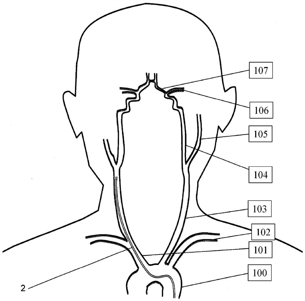 Apparatus for managing acute ischemic events