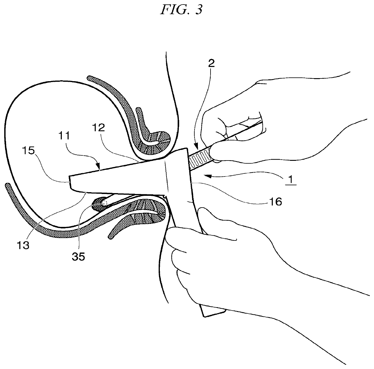 Method for determining likelihood of sporadic colorectal cancer development