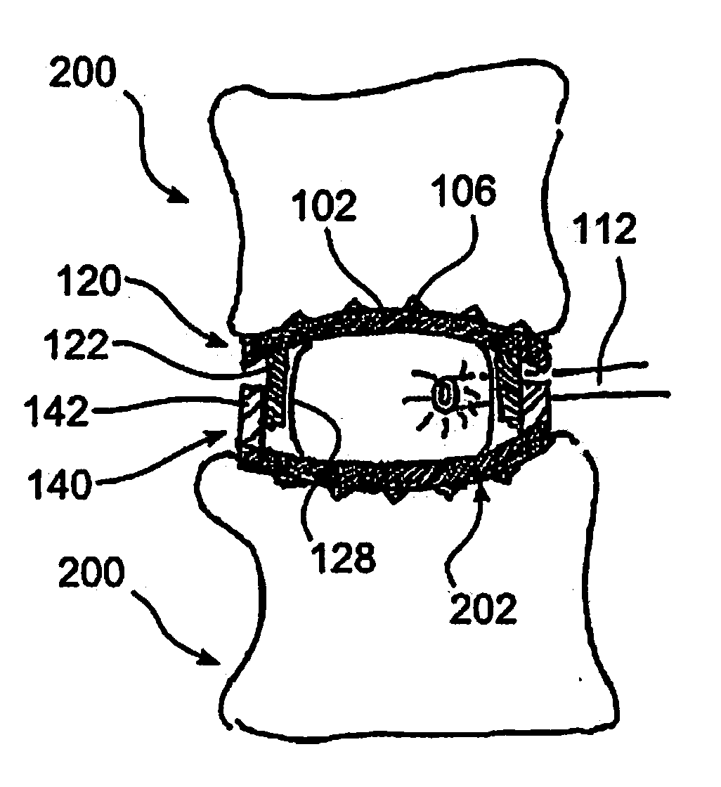 Stabilizing Vertebrae with Expandable Spacers