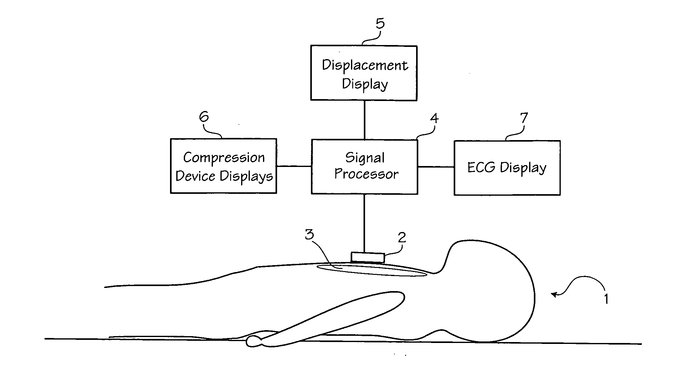 Method of estimating the actual ECG of a patient during CPR