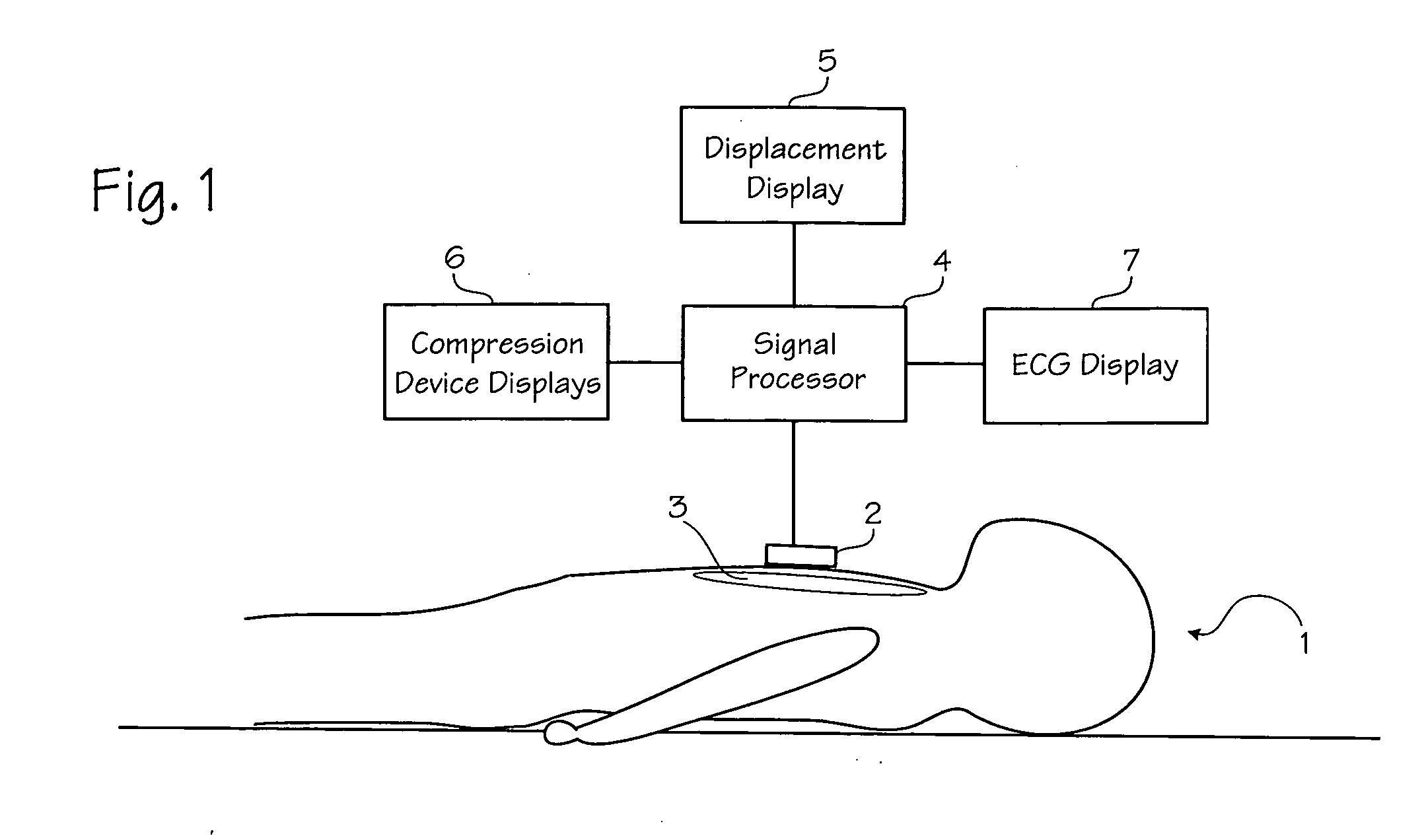 Method of estimating the actual ECG of a patient during CPR