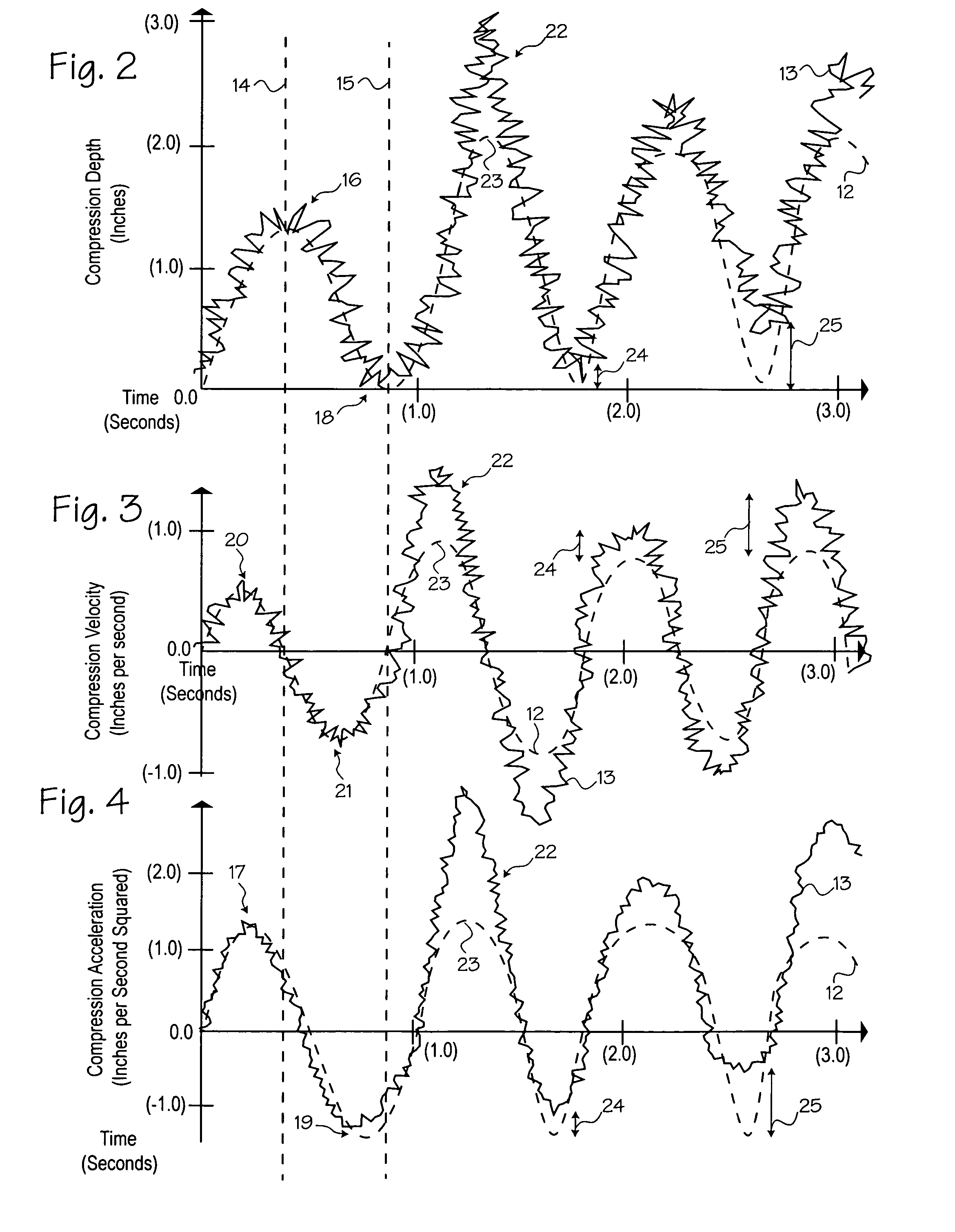 Method of estimating the actual ECG of a patient during CPR