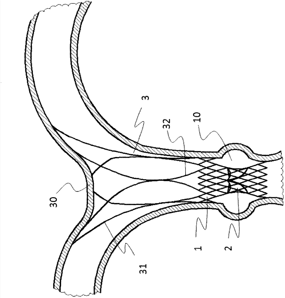 Anti-displacement pulmonary valve stent