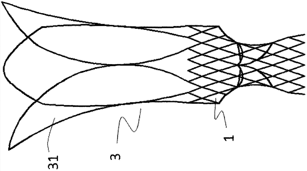 Anti-displacement pulmonary valve stent