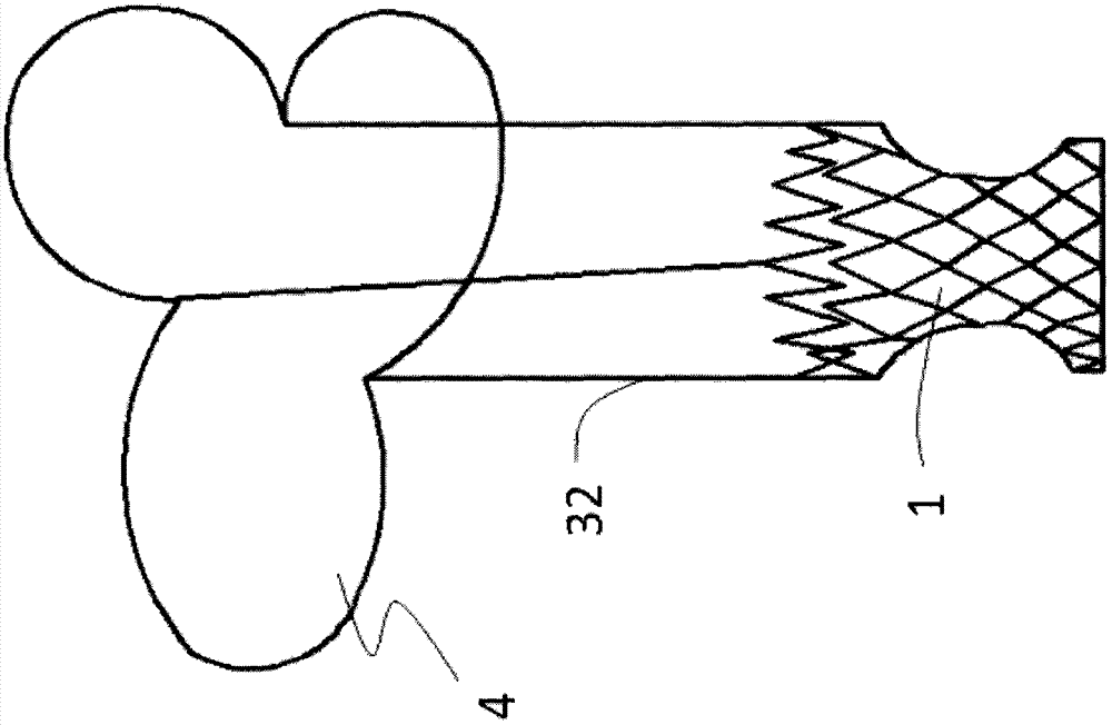 Anti-displacement pulmonary valve stent