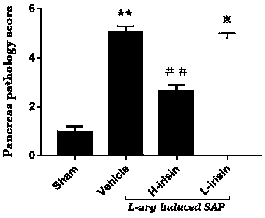 Application of irisin in drug for preventing and treating severe acute pancreatitis