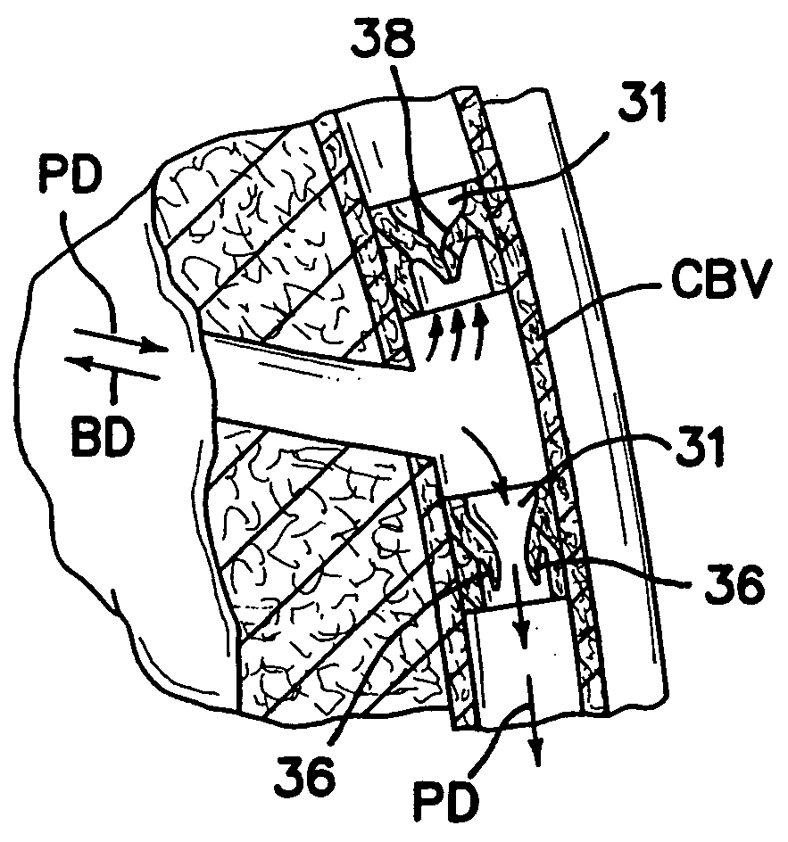 Methods and apparatus for transmyocardial direct coronary revascularization