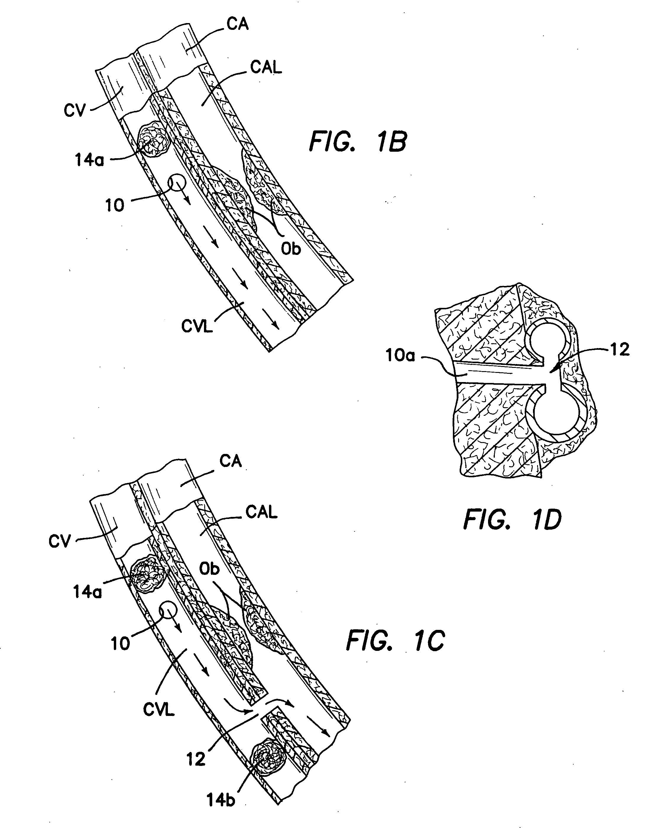 Methods and apparatus for transmyocardial direct coronary revascularization