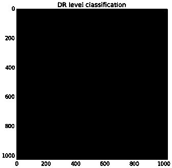 Diabetic retinopathy classification method by using super lightweight SqueezeNet network