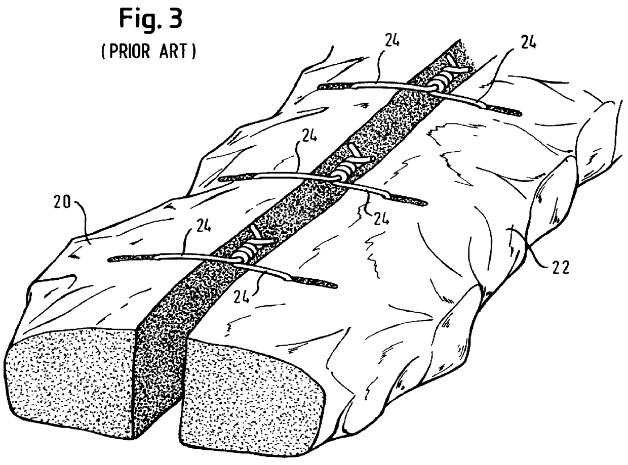 Sternal closure technique and kit for performing same