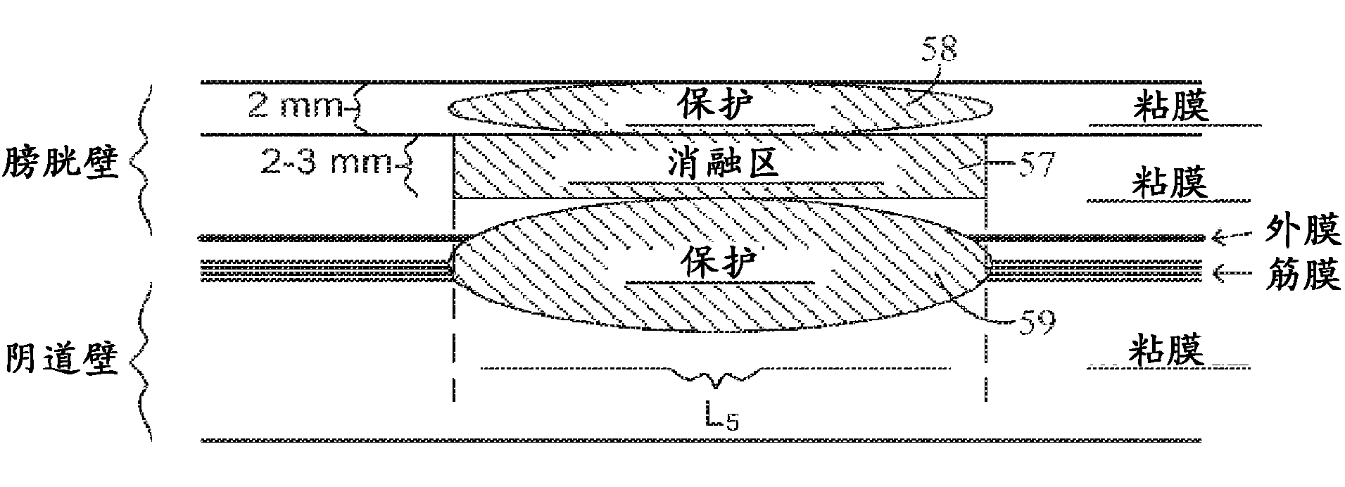 Apparatus and methods to modulate pelvic nervous tissue