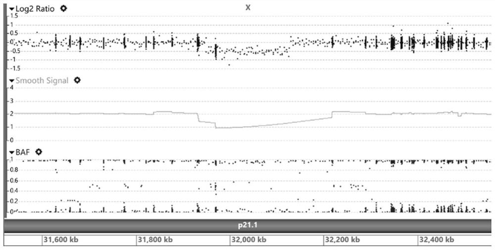 Kit and method for integrally and comprehensively detecting five complex genetic diseases