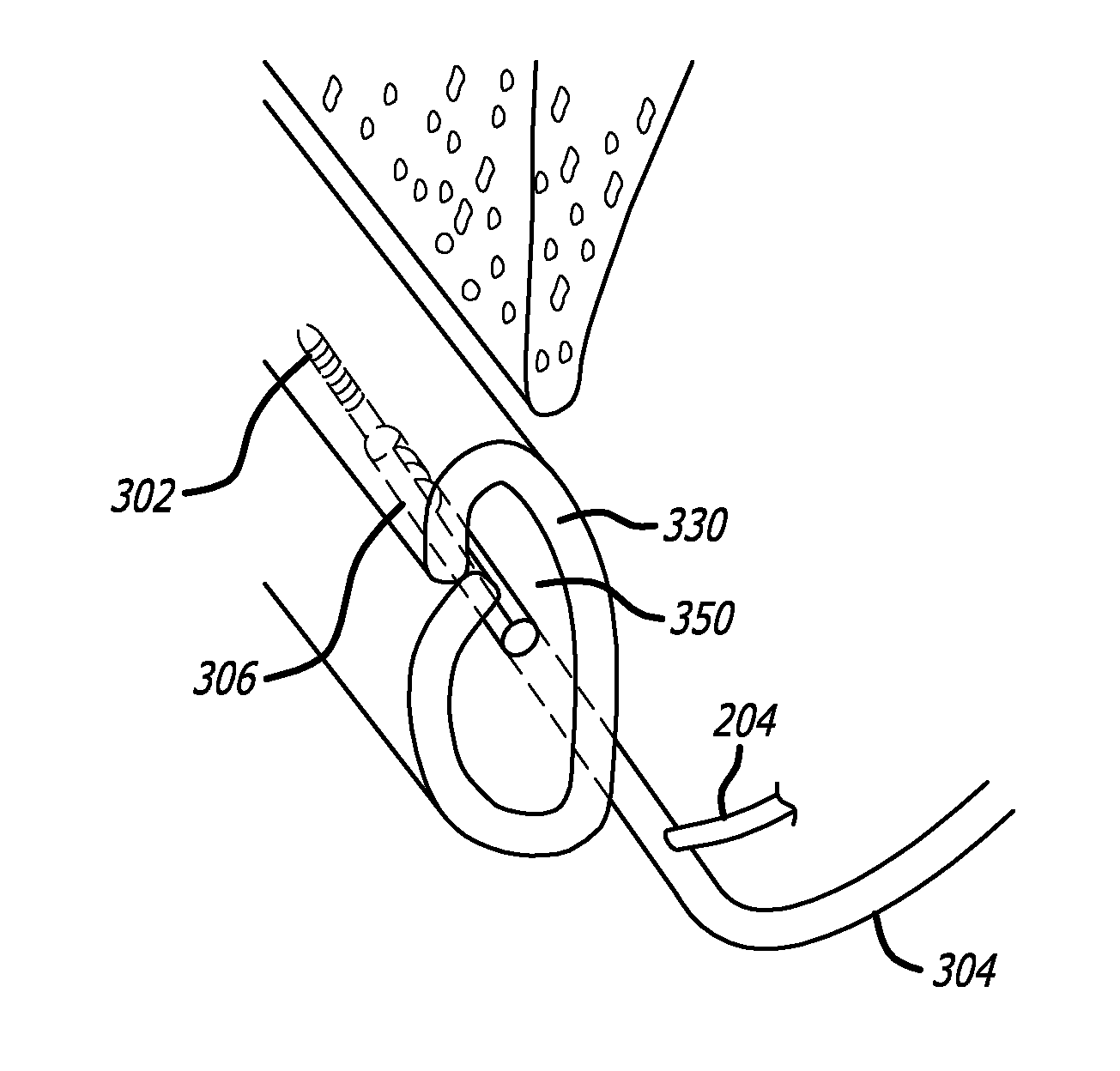 Method and System for Treating Target Tissue Within the Eustachian Tube