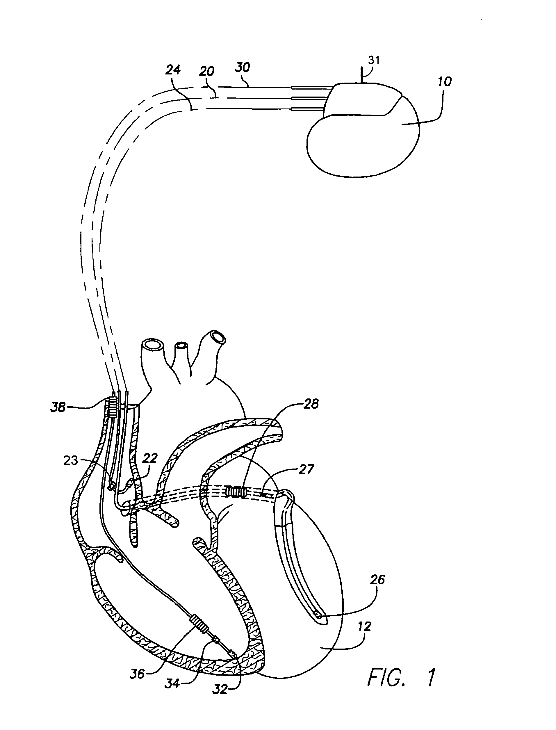 Method and apparatus for monitoring drug effects on cardiac electrical signals using an implantable cardiac stimulation device