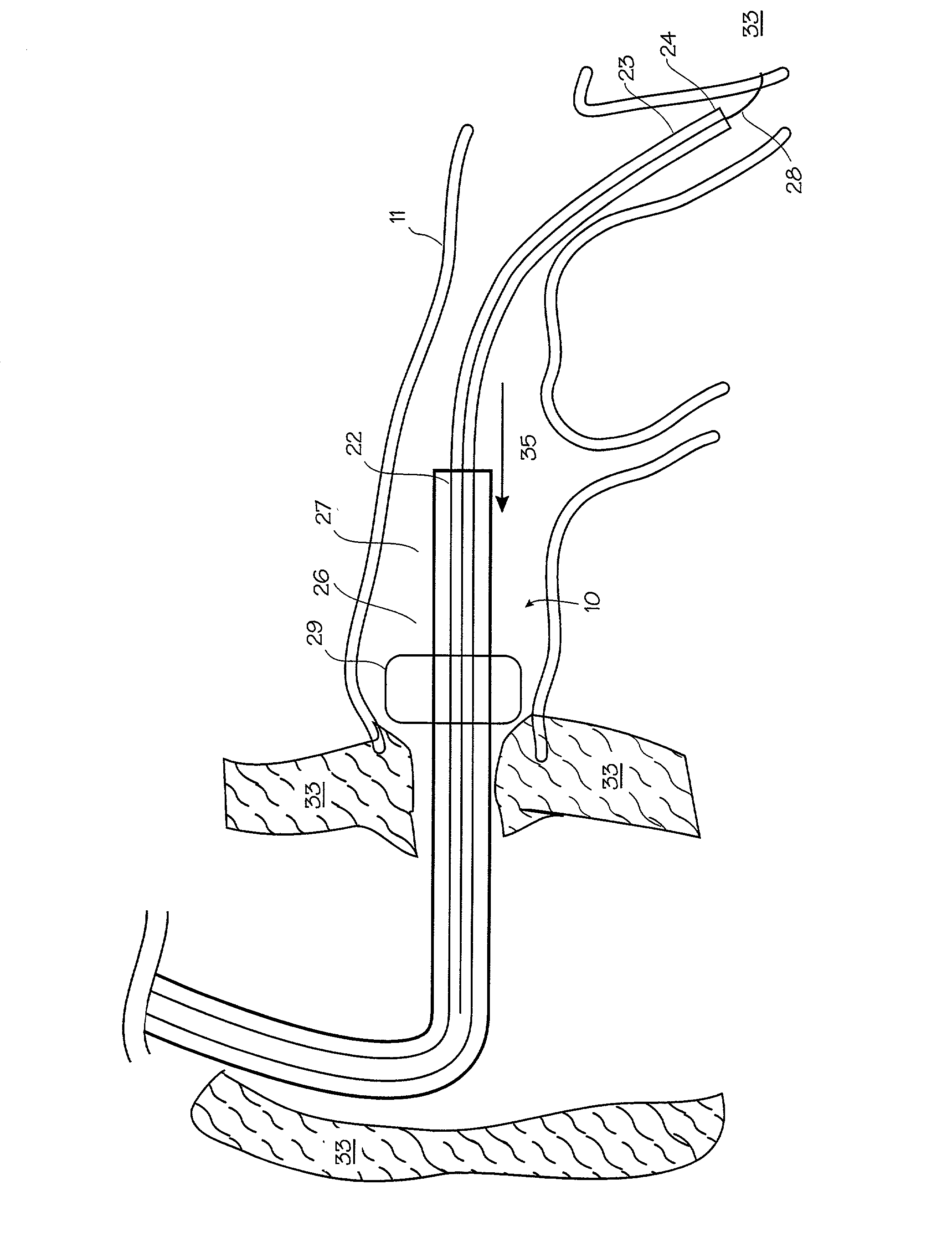 Method of treating the heart