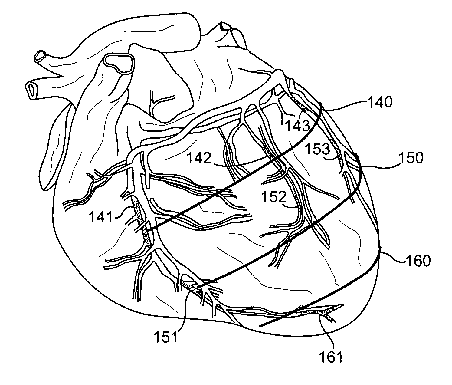 Cardiac repair, resizing and reshaping using the venous system of the heart