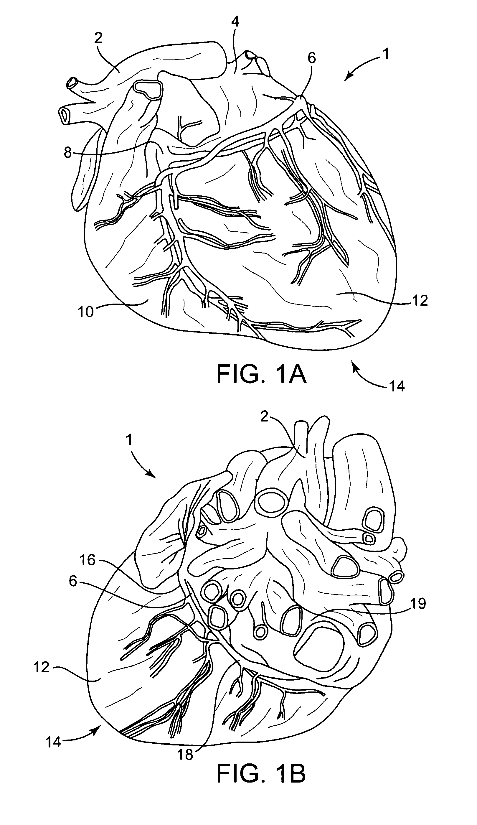 Cardiac repair, resizing and reshaping using the venous system of the heart