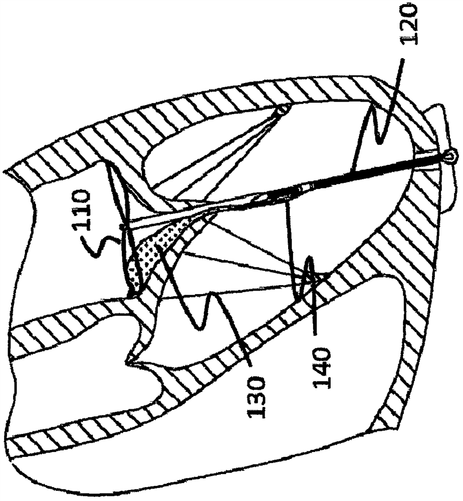 Implantation device and delivery system for preventing valvular regurgitation