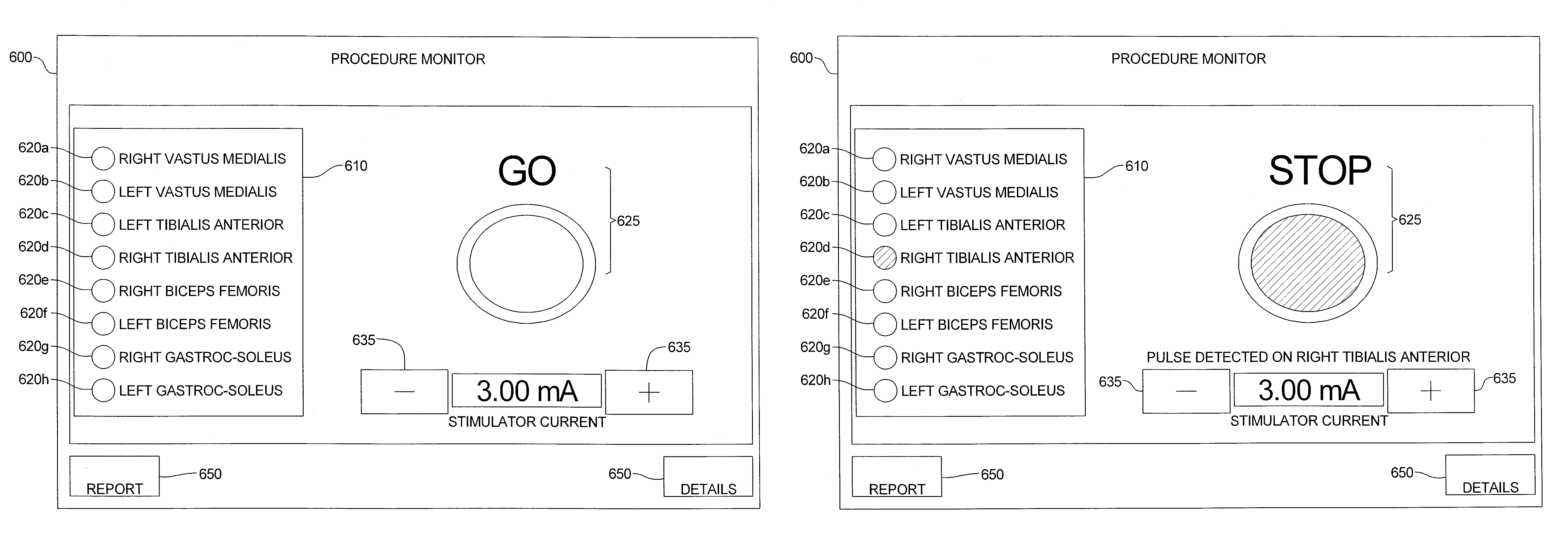 Minimally invasive nerve monitoring device and method