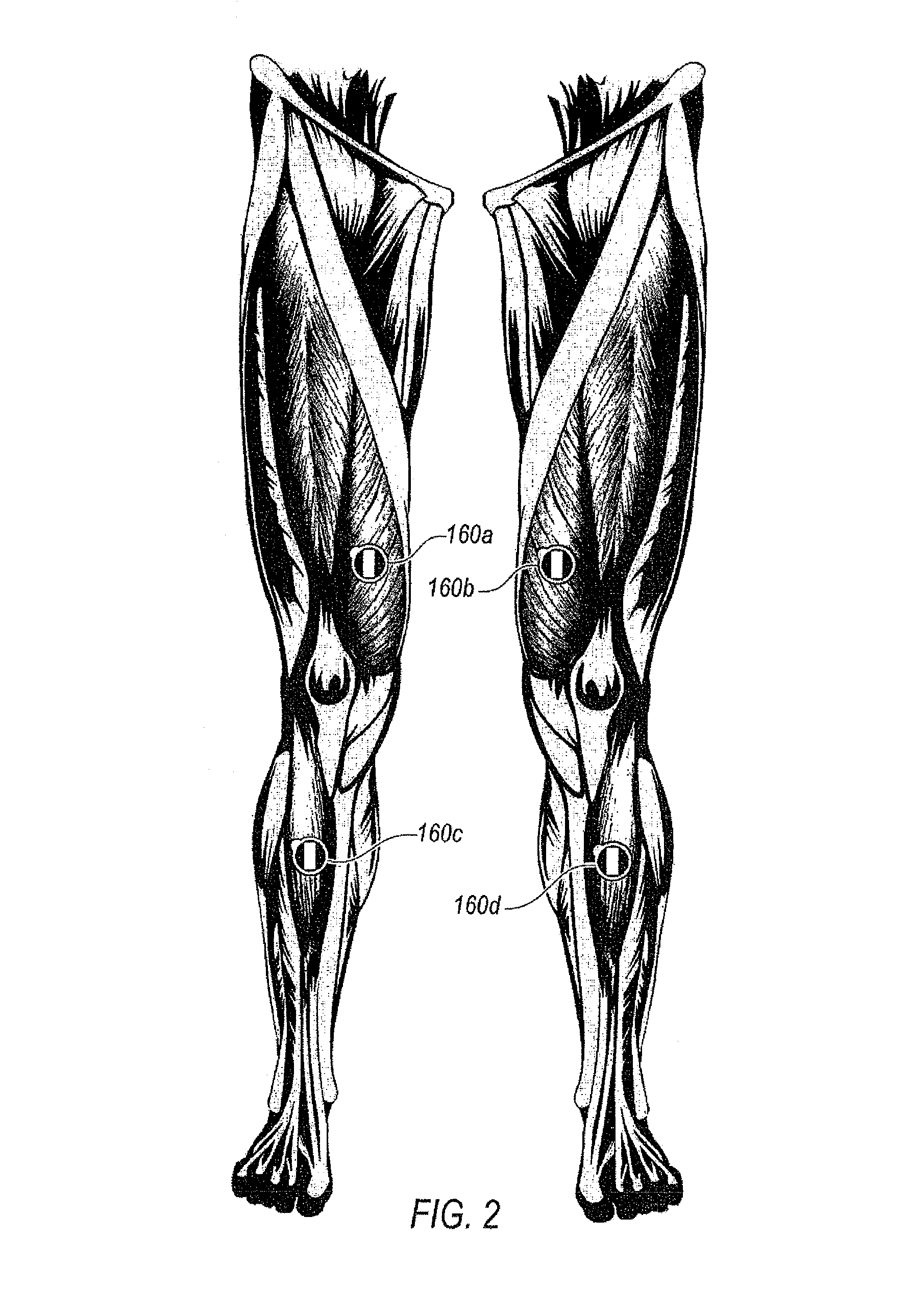 Minimally invasive nerve monitoring device and method