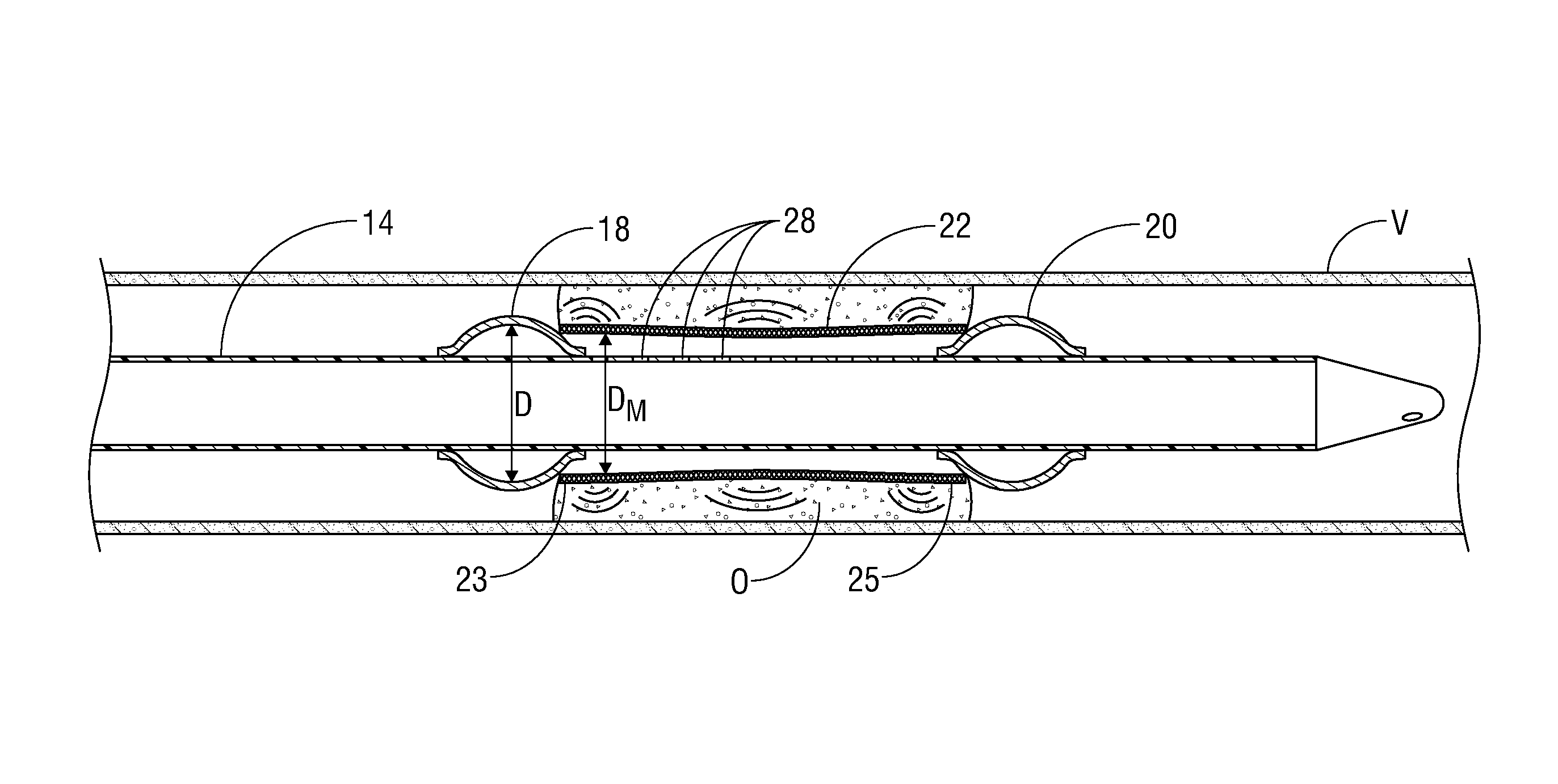 Apparatus and method for removing occlusive tissue