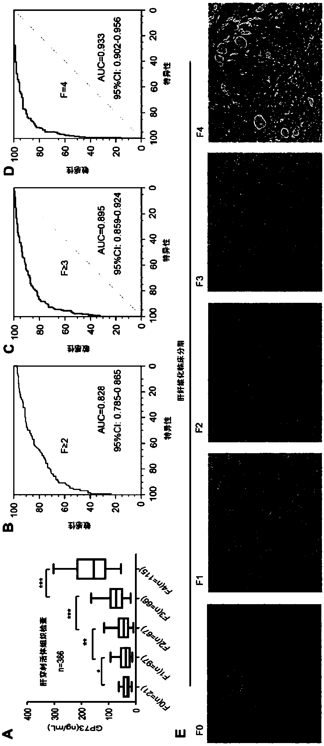 A new marker of cirrhosis or fibrosis