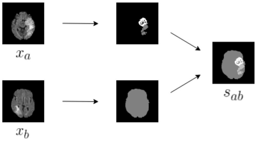 Brain tumor segmentation data enhancement method based on generative adversarial network