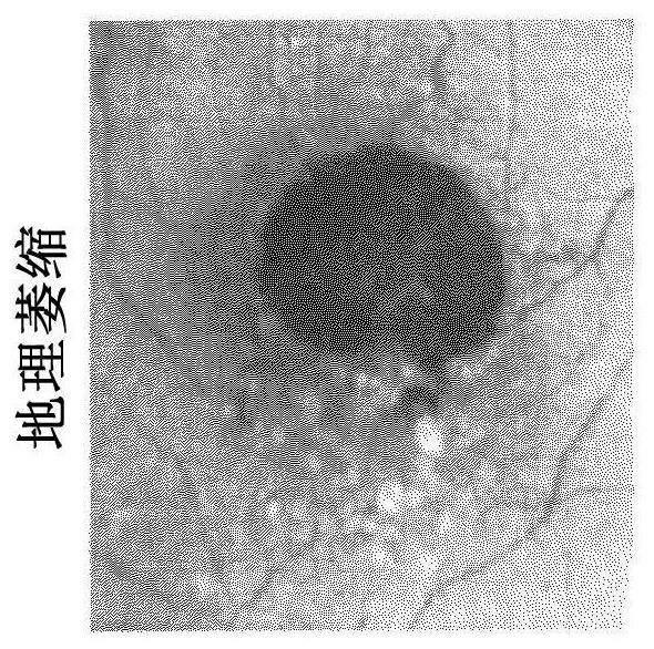 Segmentation and classification of geographic atrophy patterns in patients with age related macular degeneration in widefield autofluorescence images