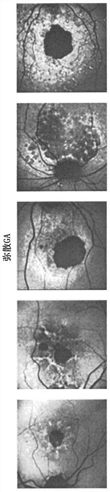 Segmentation and classification of geographic atrophy patterns in patients with age related macular degeneration in widefield autofluorescence images