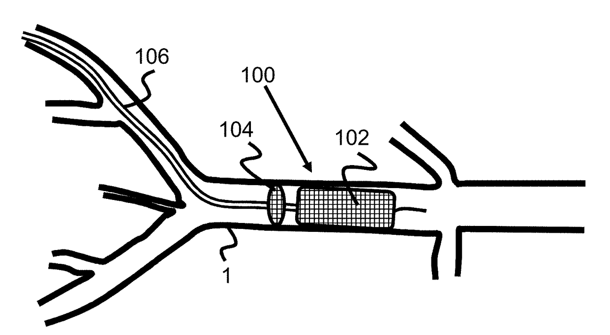 Temporary Aortic Occlusion Device