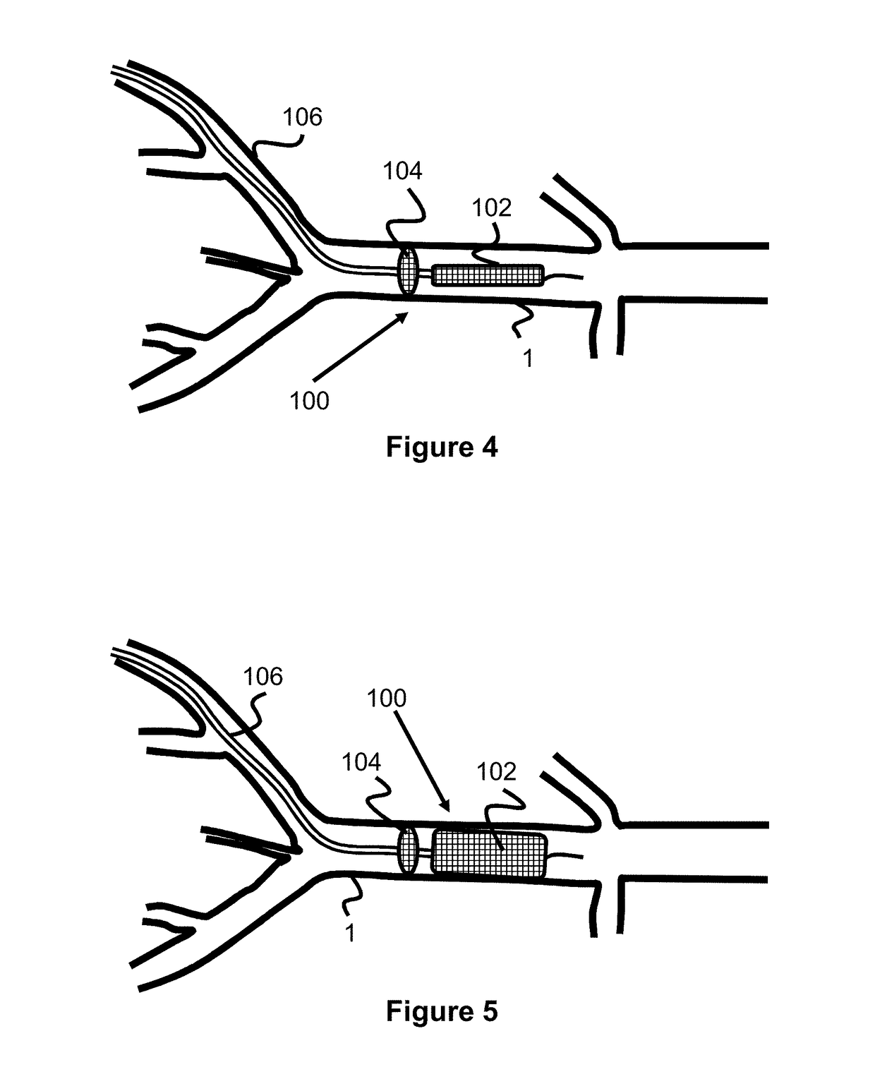 Temporary Aortic Occlusion Device