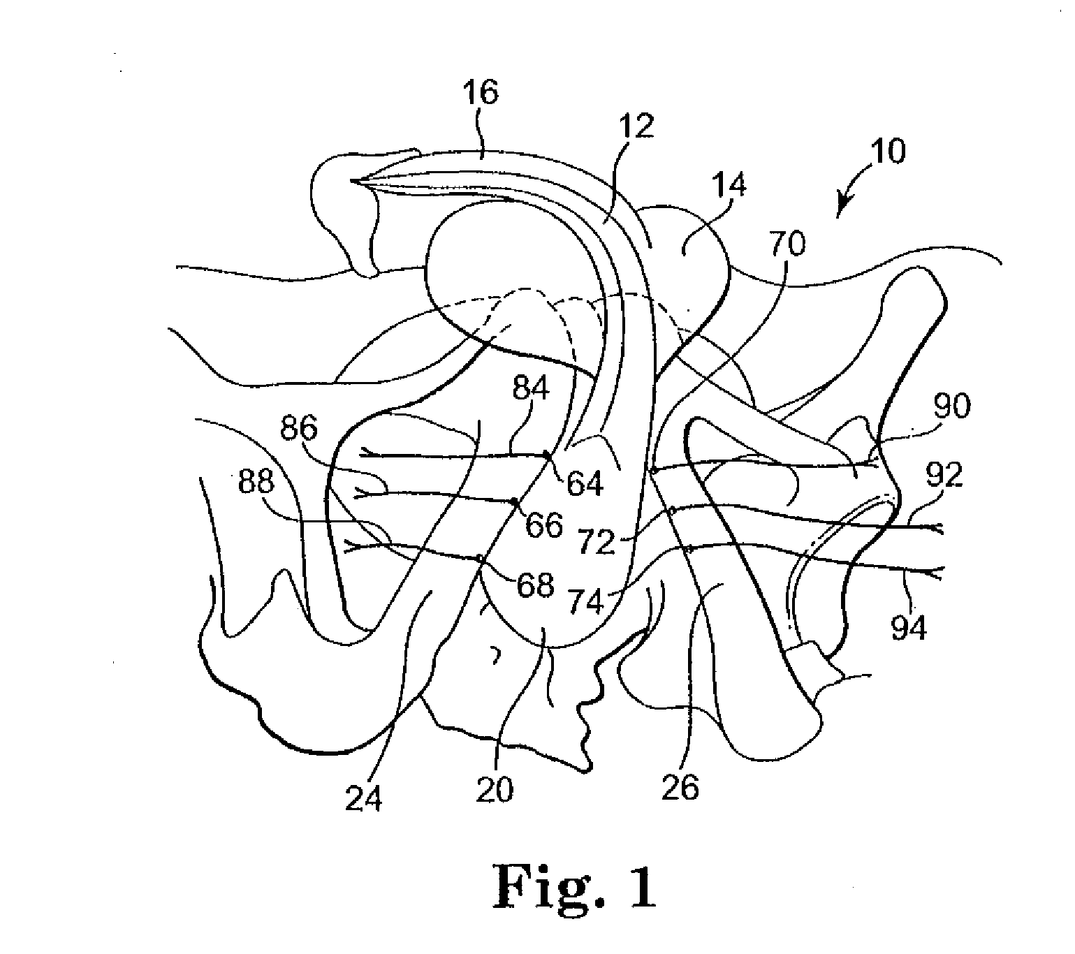 Methods and apparatus for securing and tensioning a urethral sling to pubic bone