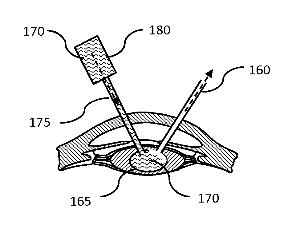 Cataract Removal using Ultra-Short Pulse Lasers