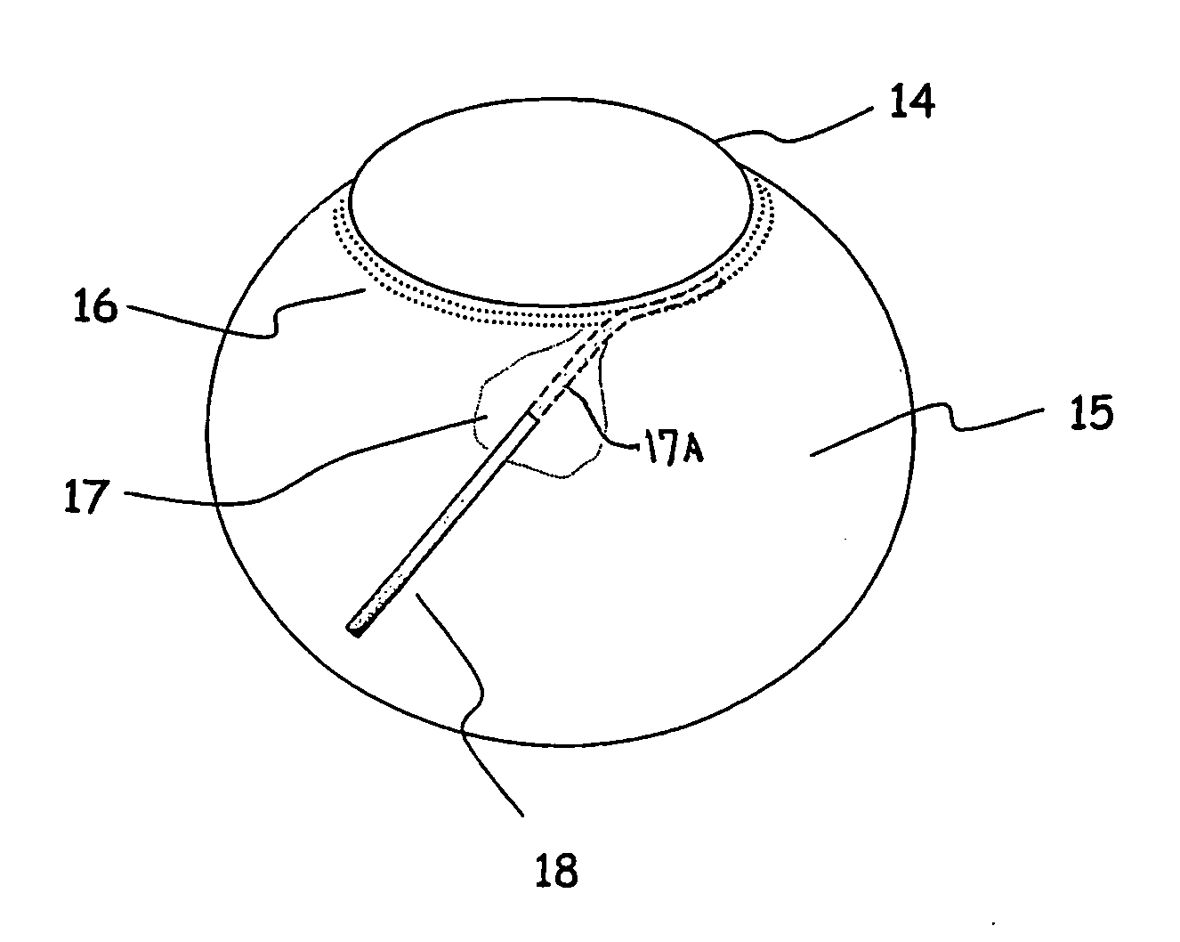 Apparatus And Method For Surgical Enhancement Of Aqueous Humor Drainage