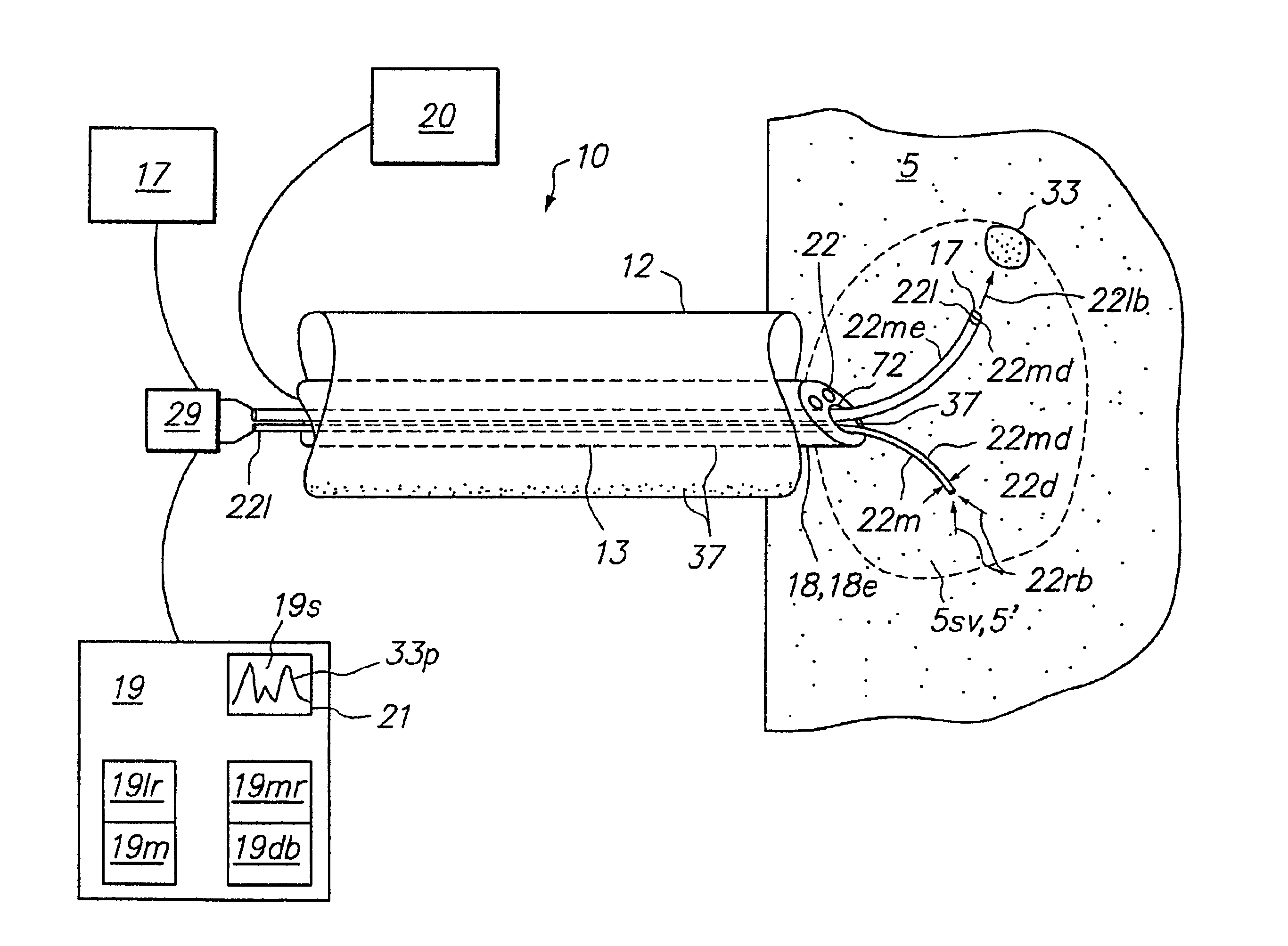 Tissue biopsy and treatment apparatus and method