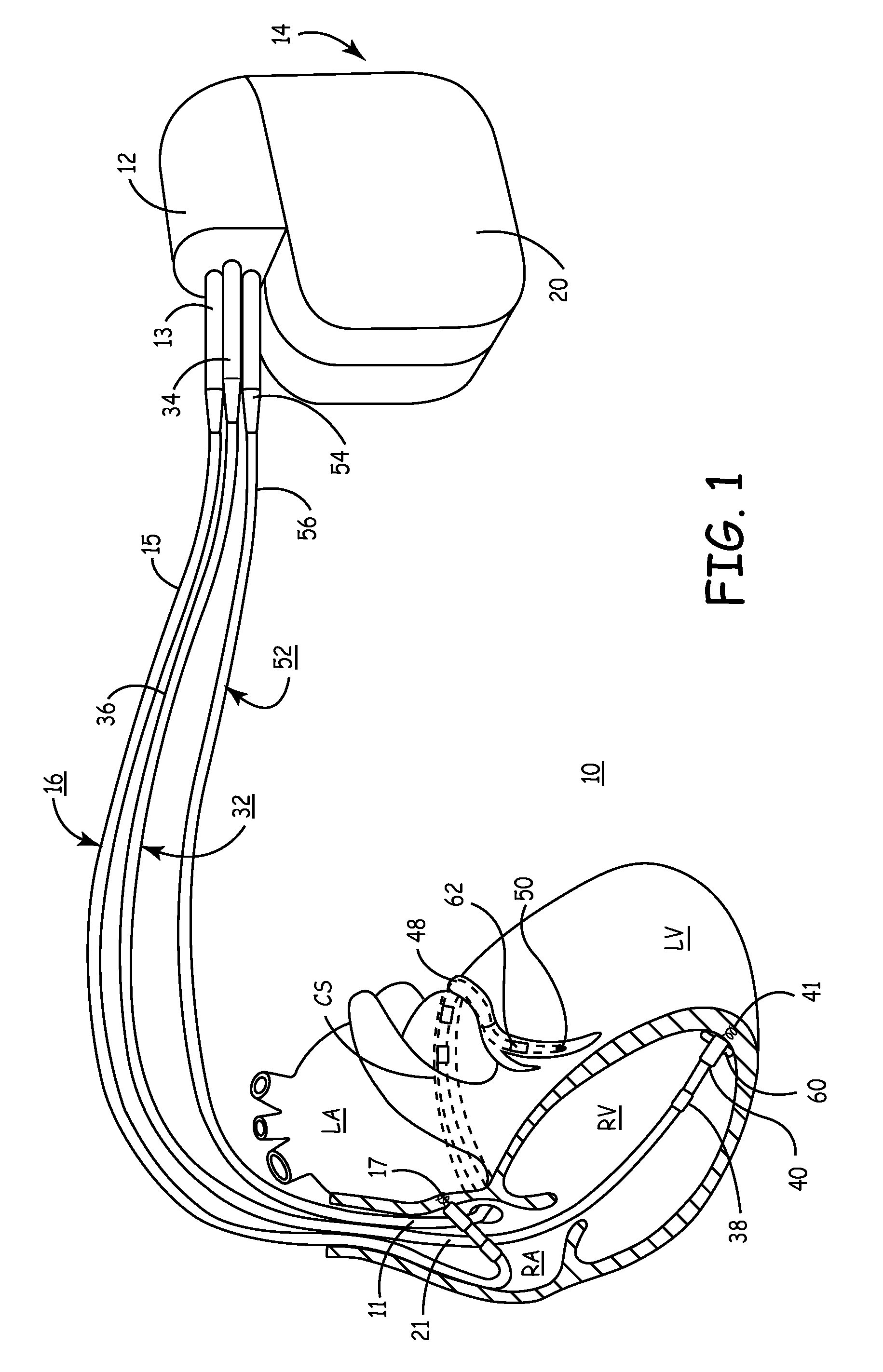 Method and apparatus for determining an efficacious atrioventricular delay interval