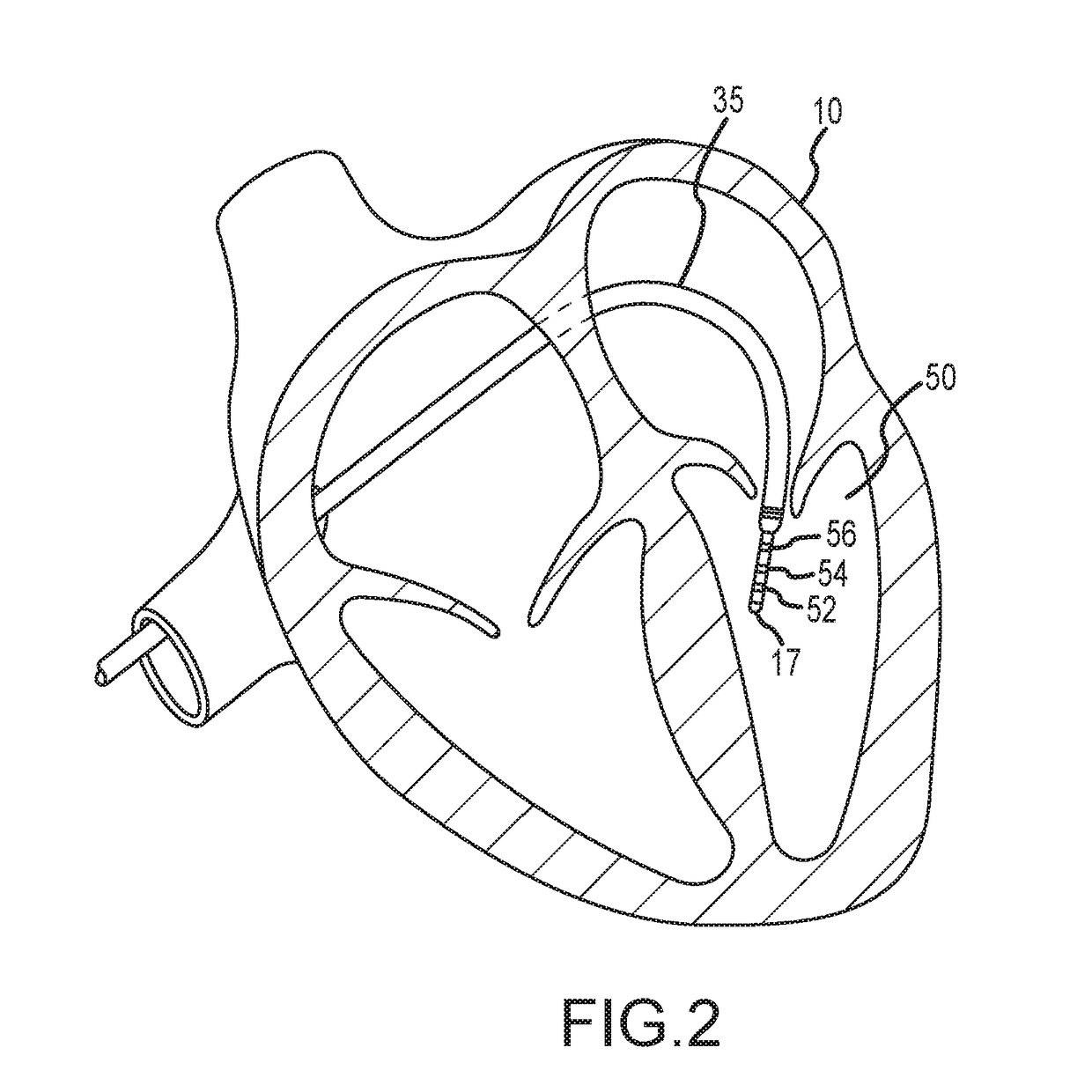 System and Method for Electrophysiology Procedures