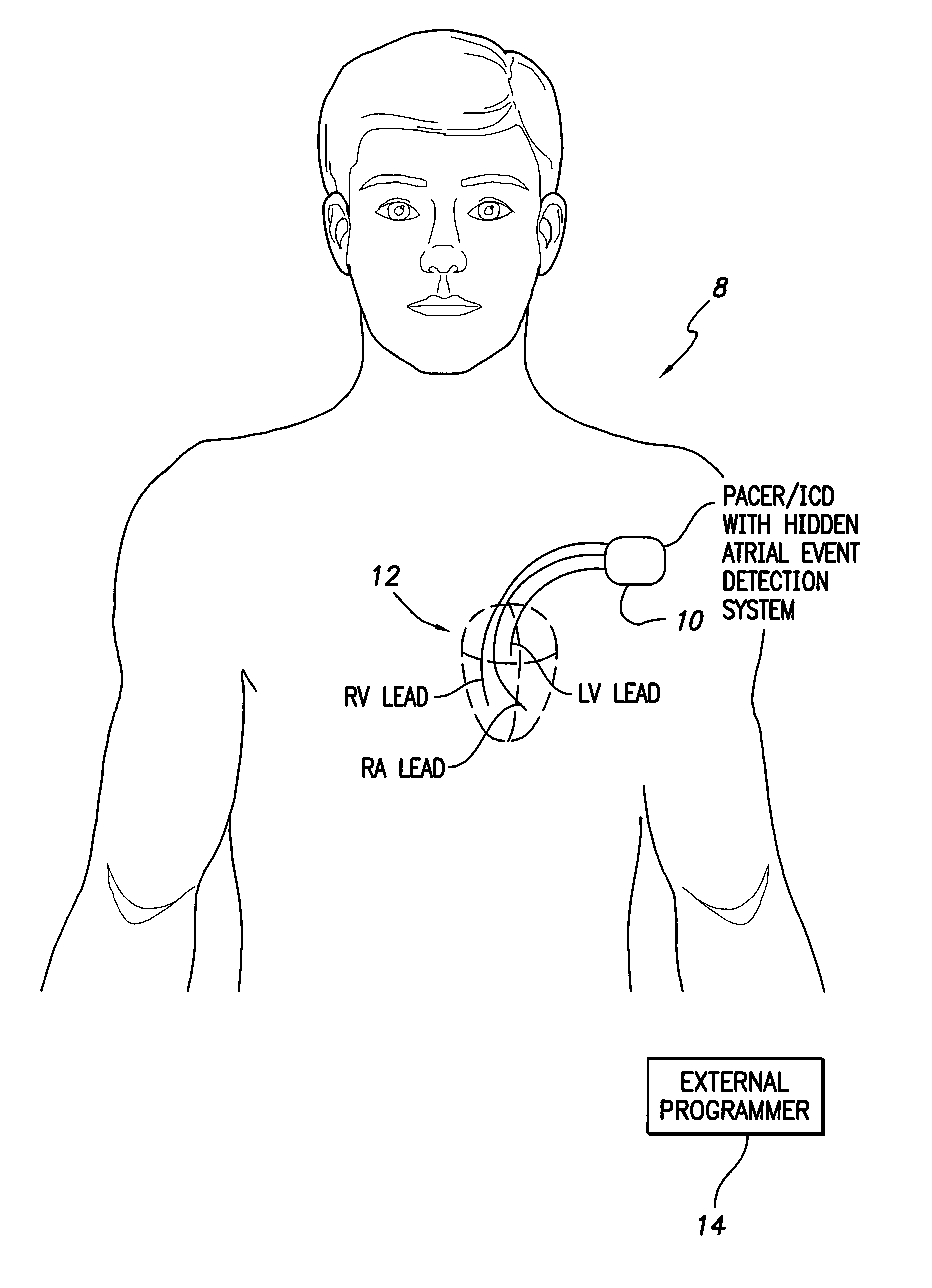 System and method for detecting hidden atrial events for use with automatic mode switching within an implantable medical device