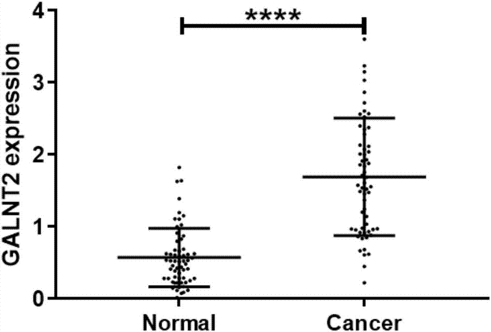 Kit for aided-diagnosis and prognostic evaluation on non-small cell lung cancer based on gene GALNT2 and use method thereof